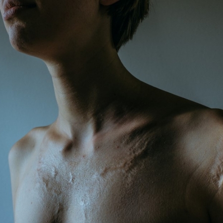 Τα σημάδια στο σώμα μας είναι παράσημα ζωής