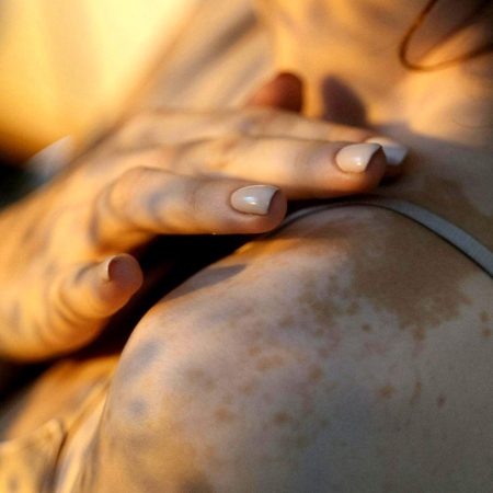 «Μη με κοιτάτε περίεργα, είναι απλά λεύκη!»